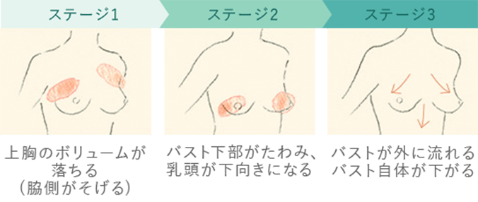 ステージ1.上胸のボリュームが落ちる(脇側がそげる) ステージ2.バスト下部がたわみ、乳頭が下向きになる ステージ3.バストが外に流れる。バスト自体が下がる